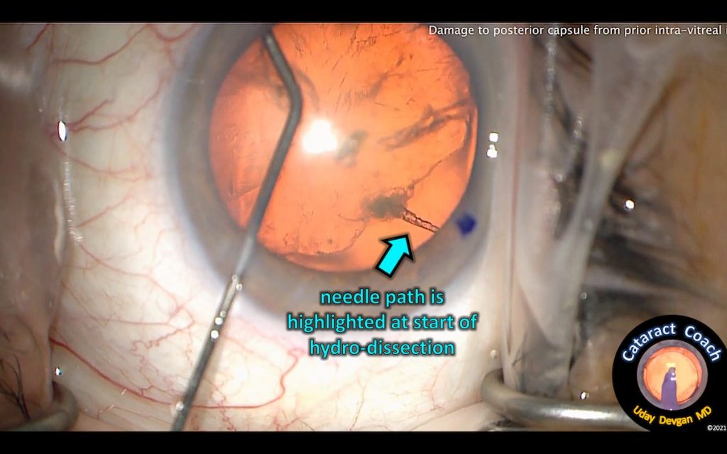 Cataract Surgery after lens trauma from Intravitreal Injection | Dr ...