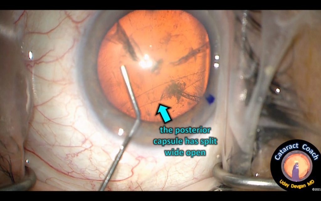 Cataract Surgery after lens trauma from Intravitreal Injection Dr. Uday Devgan IVEG