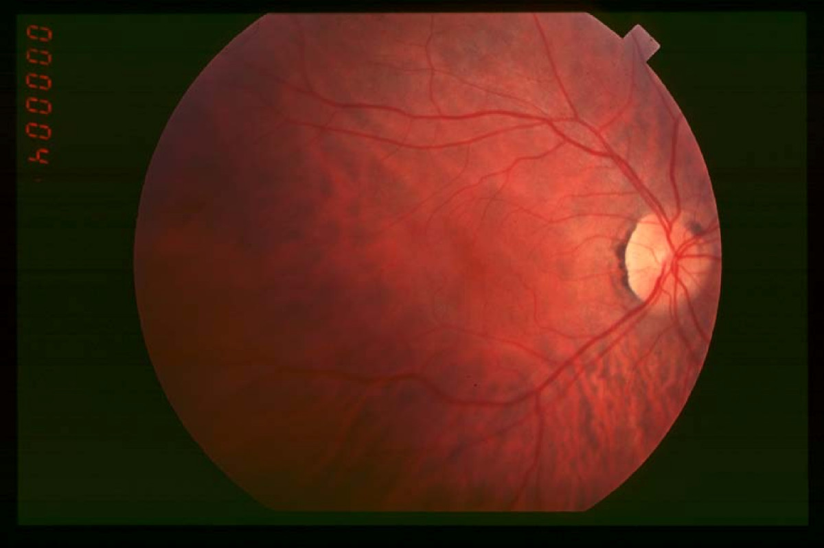 New treatment for Retinitis Pigmentosa shows positive results